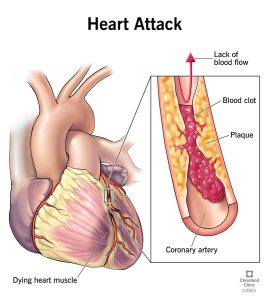 Heart Attack